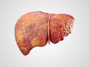 Fatty liver